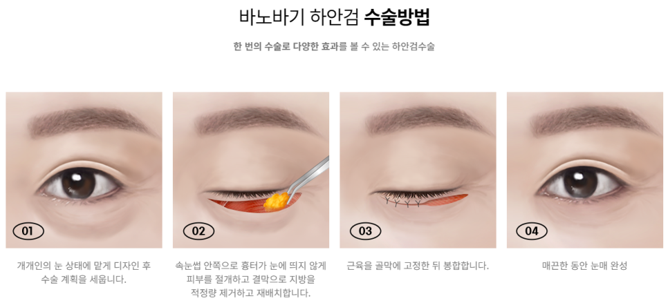 미용적+기능적 문제를 동시에 개선하다, 상안검/하안검 관련 이미지 5