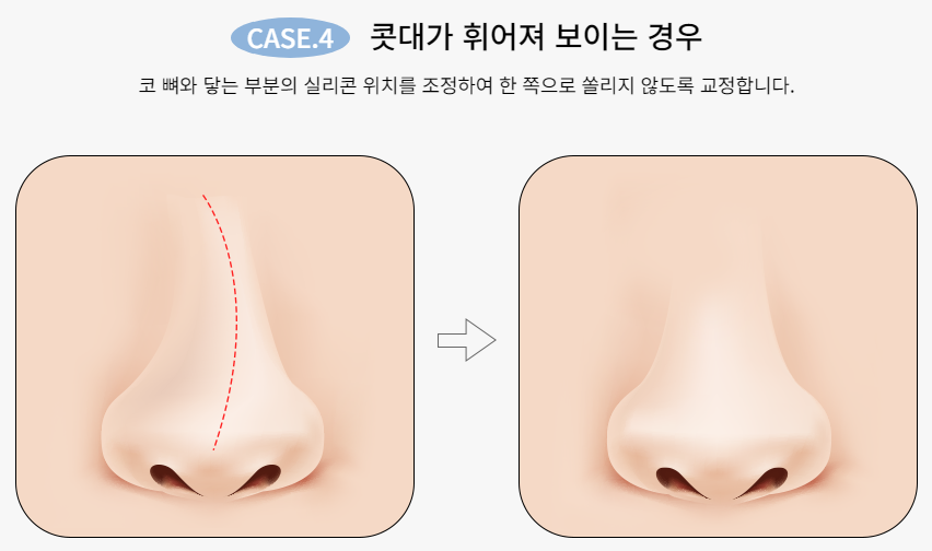 마지막 코재수술, 바노바기에서! 관련 이미지 6