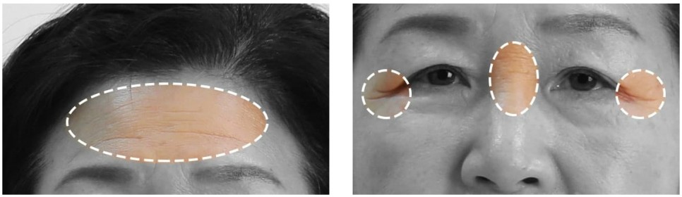 내시경 엔도타인 이마 리프팅으로 더욱 밝아지는 인상! 관련 이미지 2