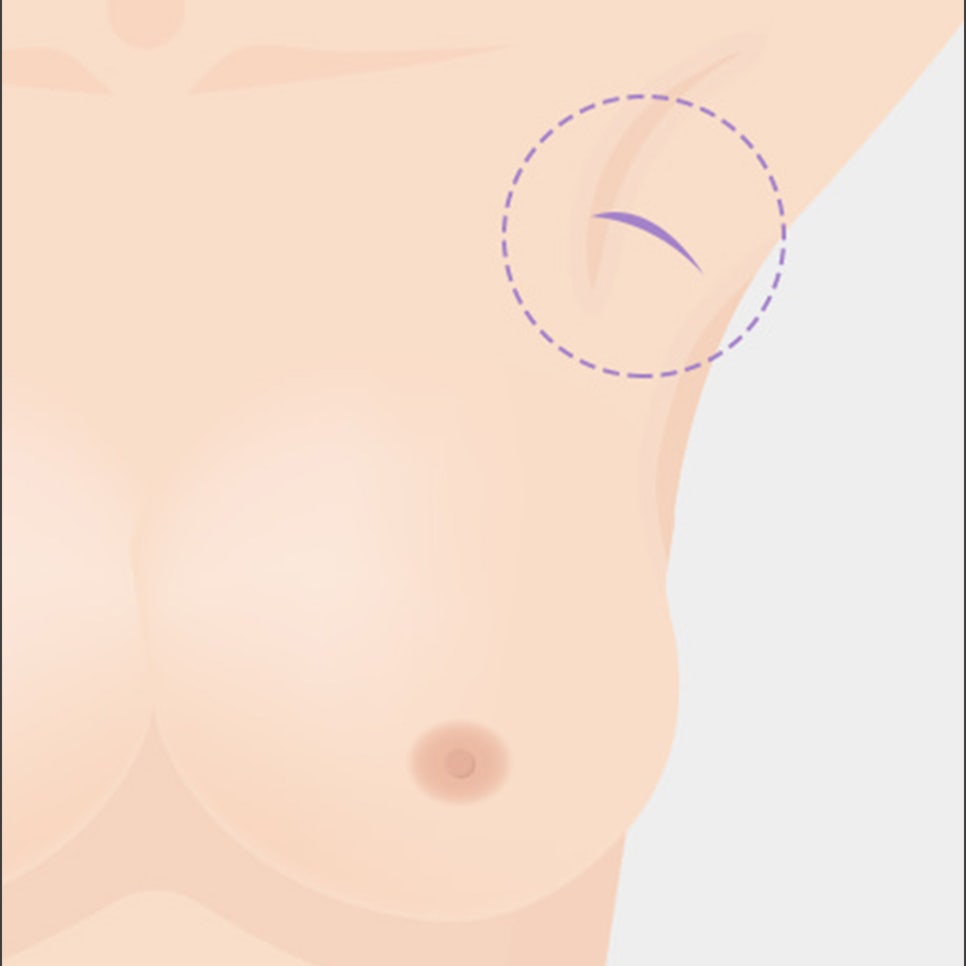 가슴 성형, 보형물의 종류와 절개법의 장단점 관련 이미지 12