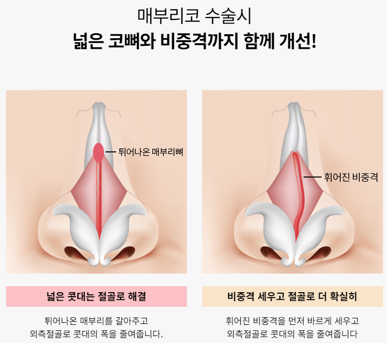 굴곡 없이 매끄럽게! 매부리코성형 관련 이미지 4