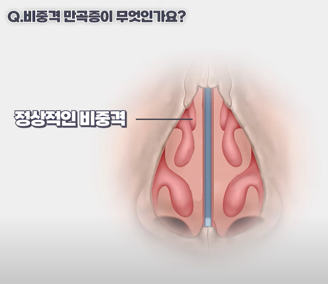 코막힘의 원인! 비중격 만곡증에 대해서 알려드립니다. 관련 이미지 1