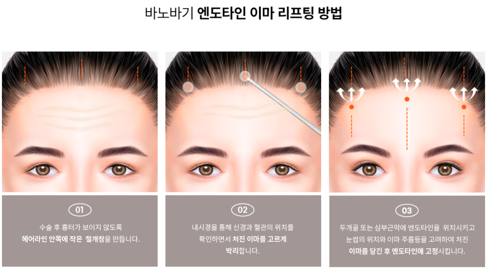 안전한 박리로 확실한 노화 개선을, 엔도타인 이마 리프팅 관련 이미지 3