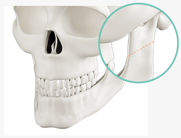안전하고 자연스럽게, 무턱 양악수술 관련 이미지 4
