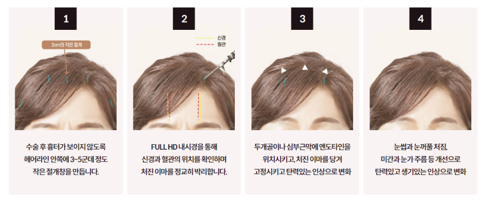 이마거상, 상안면부 노화 개선으로 더욱 밝아지는 인상 관련 이미지 4