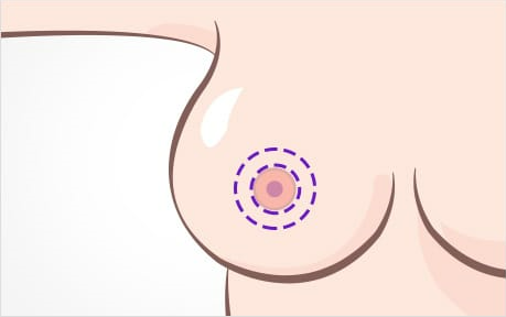 가슴처짐수술 회복과 흉터에 더욱 신경 써야 합니다. 관련 이미지 4