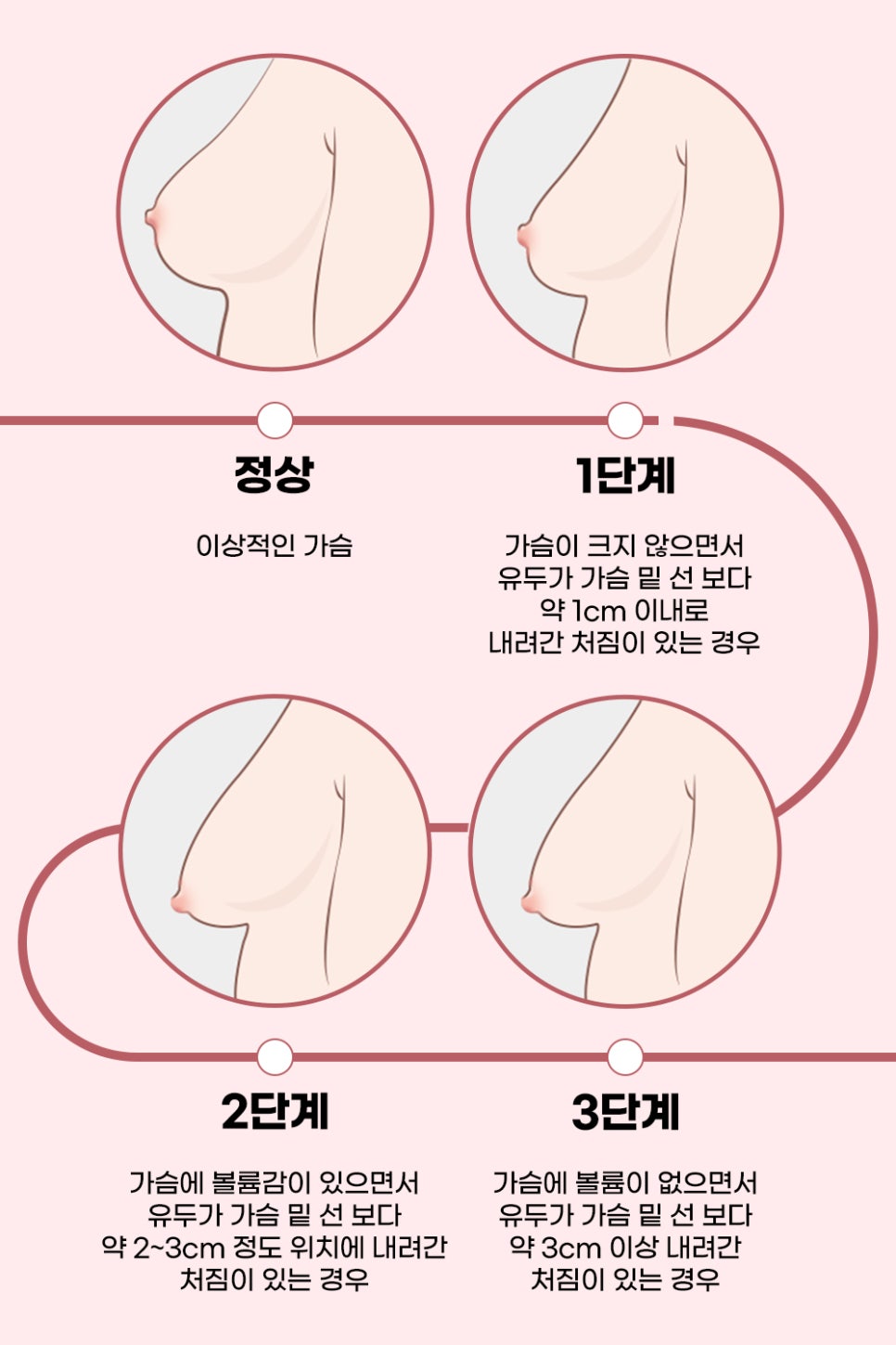 처진 가슴, 케이스에 따른 맞춤 개선으로 탄력 있고 볼륨감 있는 가슴으로! 관련 이미지 3