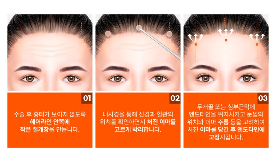 상안면부 노화, 내시경 엔도타인 이마 리프팅으로 개선 관련 이미지 3