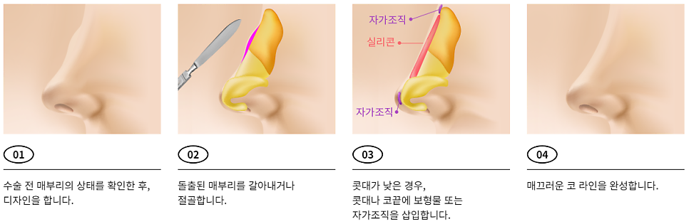 굴곡 없이 매끄럽게! 매부리코성형 관련 이미지 3
