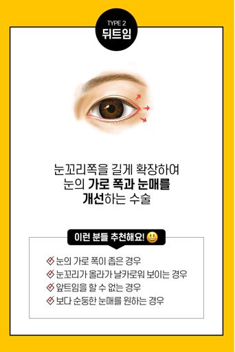 트임성형은 내 얼굴에 맞게 조화로운 비율로! 관련 이미지 4