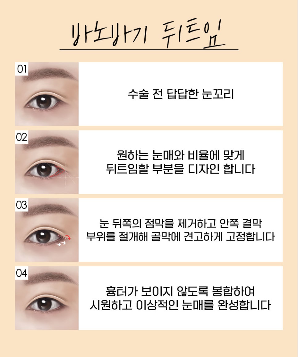 트임  성형, 얼굴에 맞는 조화로운 눈의 비율과 시원한 눈매로 개선 관련 이미지 4