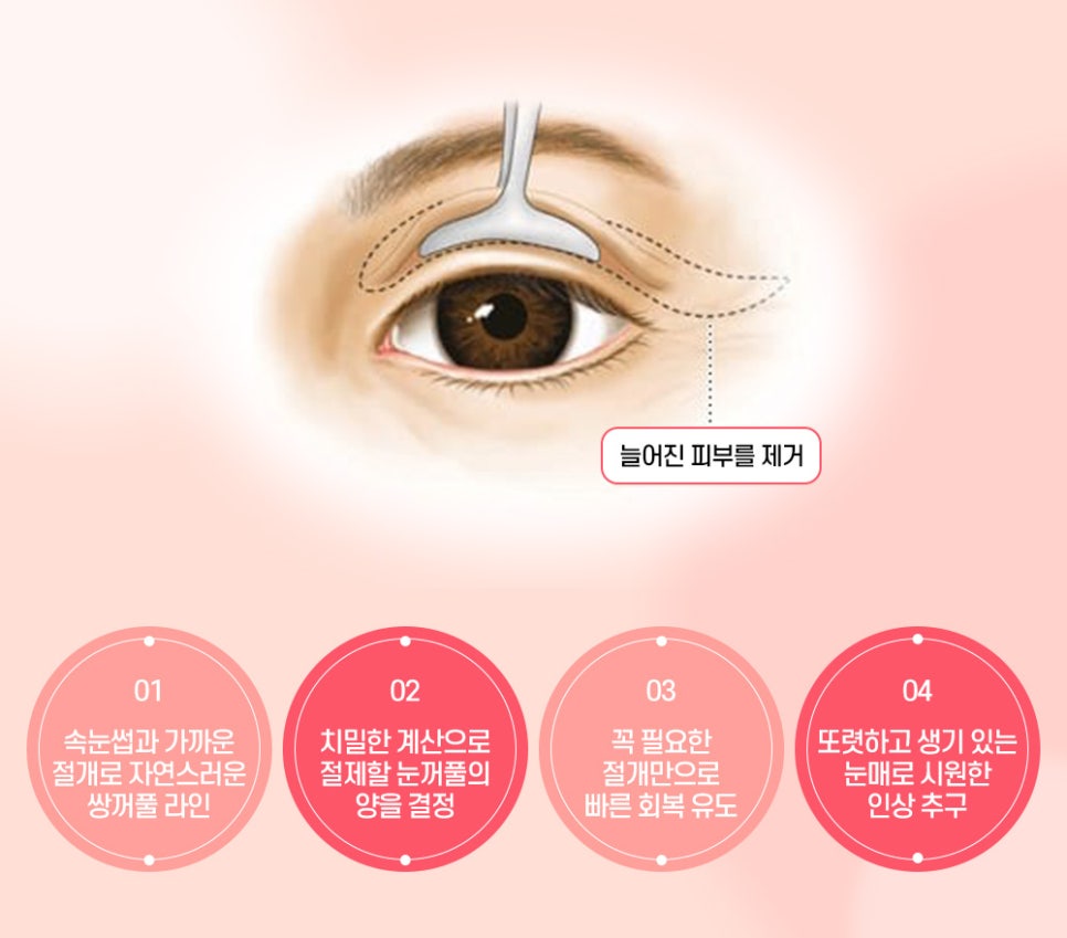 중년 눈꺼풀 처짐은 상안검 수술을 통해 개선 할 수 있습니다. 관련 이미지 5