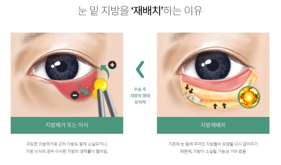 눈밑지방재배치유명한곳 경력을 봐야 실력을 압니다. 관련 이미지 3
