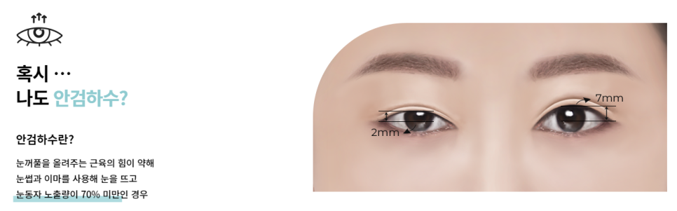 답답한 눈, 눈매교정으로 뚜렷하게! 관련 이미지 2