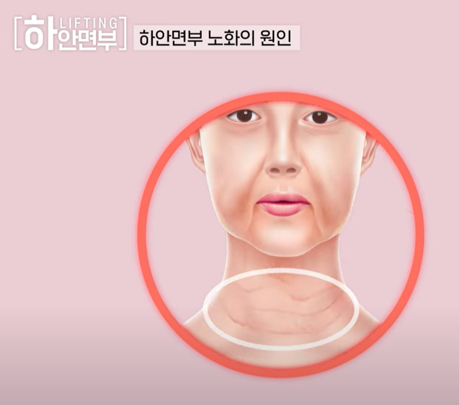 하안면부 노화는 근본적인 원인을 해결해야 한다! 관련 이미지 3