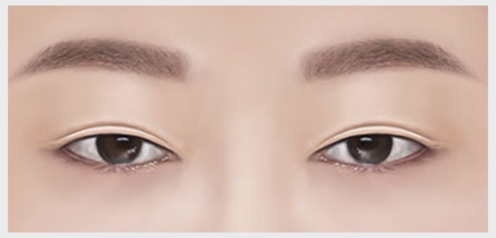 쌍꺼풀 재수술이 필요한 유형과 원인에 맞는 재수술 방법 관련 이미지 5