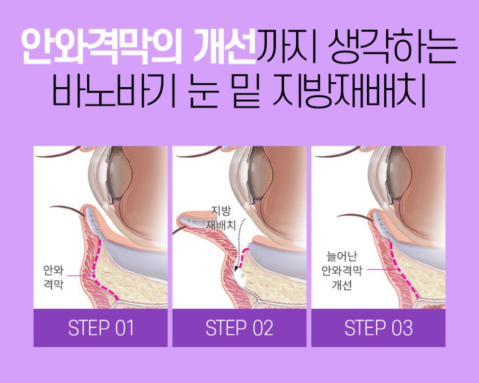 어두운 눈가를 개선하는 눈 밑 지방재배치의 장점과 수술법 관련 이미지 4
