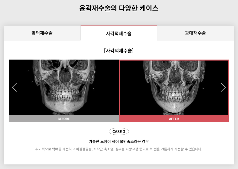 다시 되찾는 아름다운 미소! 윤곽재수술 관련 이미지 6