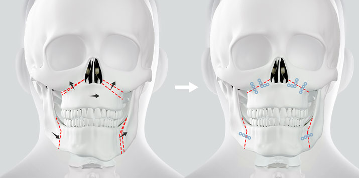 안면비대칭, 정확한 원인 분석으로  한 번에 개선 관련 이미지 3