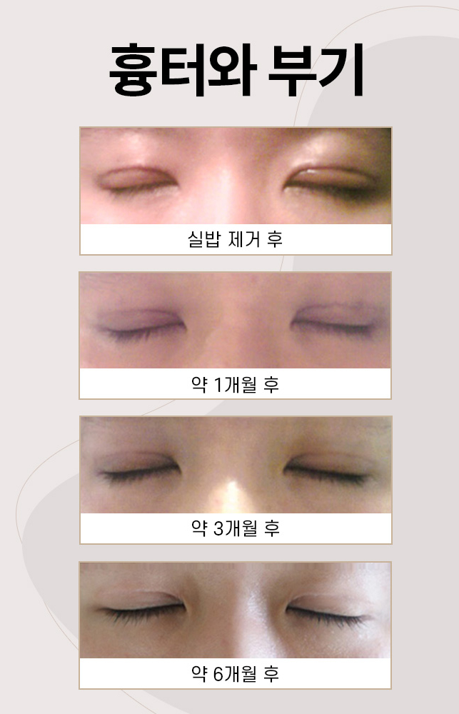 절개 쌍꺼풀 수술도 매몰처럼 자연스러운 라인이 가능한 이유! 관련 이미지 4