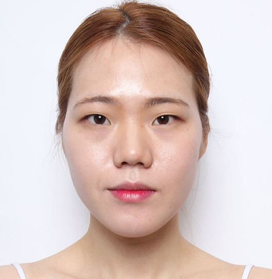 광대뼈축소 45도광대 이렇게 축소해야합니다! 관련 이미지 3