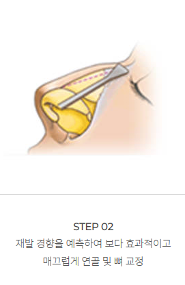 남자에게 맞는 코 성형과 개선 방법! 관련 이미지 7
