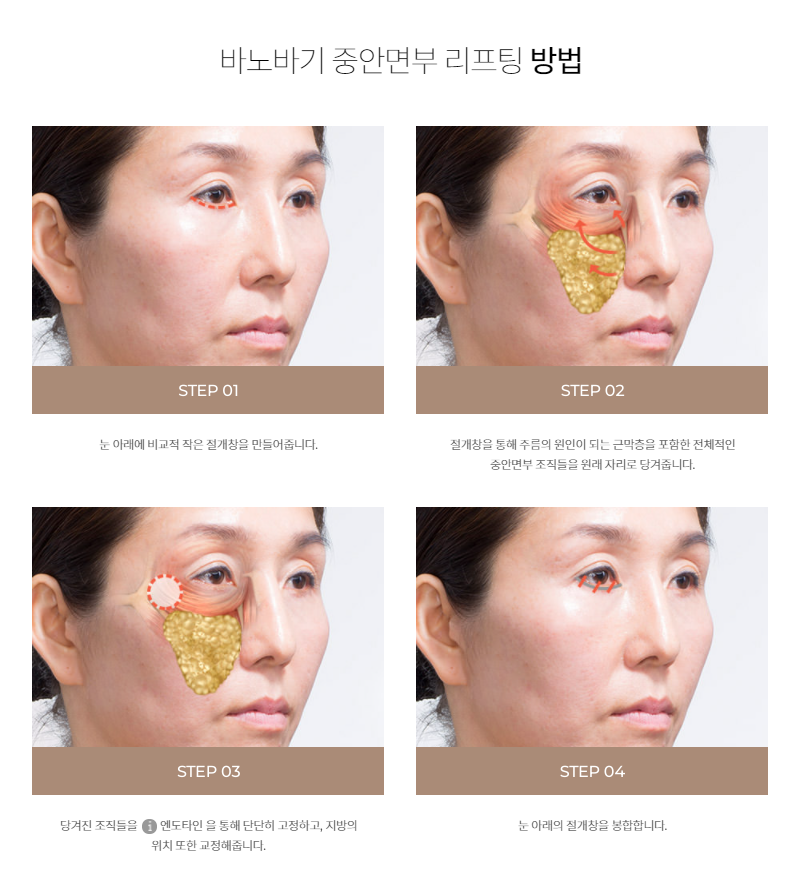 중안면부리프팅 팔자주름을 효과적으로 당기다! 관련 이미지 4