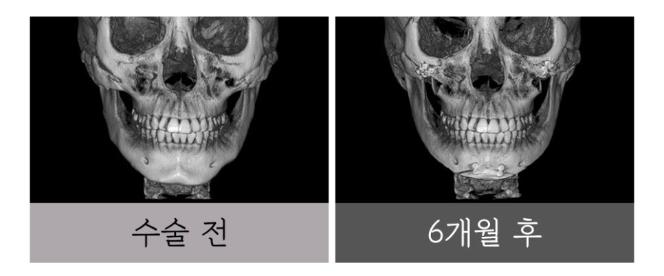 윤곽 재수술, 정밀한 진단과 치밀한 설계로 바로잡아야 합니다. 관련 이미지 3