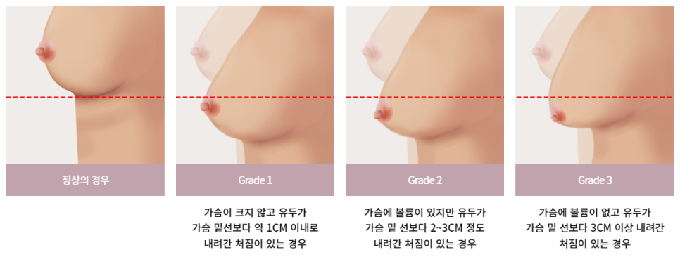 처진 가슴, 맞춤 개선으로 자신감 UP 관련 이미지 5