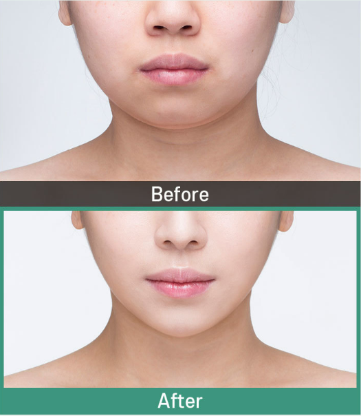 바노바기 미니V리프팅으로 피부 탄력과 턱선 개선까지! 관련 이미지 4