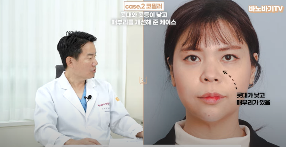 아테콜 필러의 장점과 아테콜 추천 부위는?! 관련 이미지 11