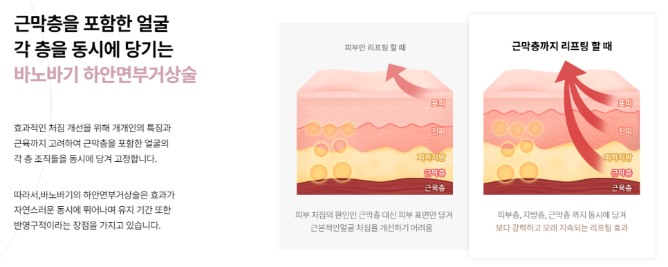 근막층까지 당겨 더욱 강력하게! 하안면부거상술 관련 이미지 3