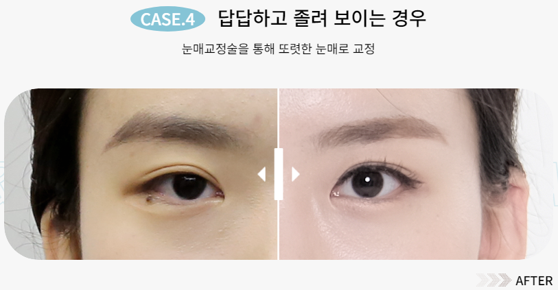 예쁜 눈매를 되찾는 방법, 눈 재수술 관련 이미지 6