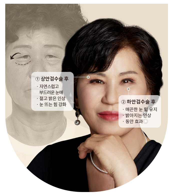 미용적+기능적 문제를 동시에 개선하다, 상안검/하안검 관련 이미지 2