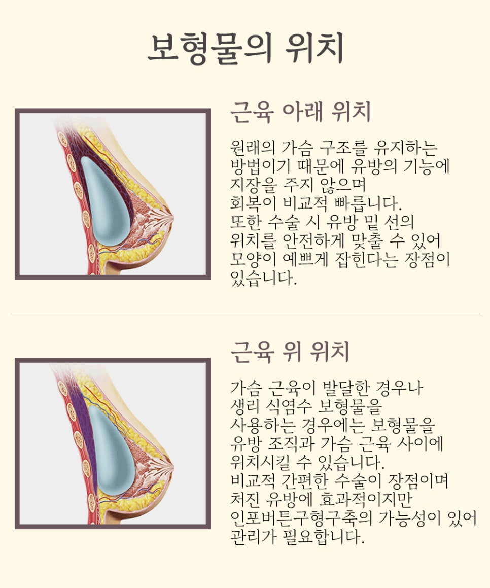 가슴 성형 수술의 핵심! 보형물의 종류와 위치, 절개법 관련 이미지 6
