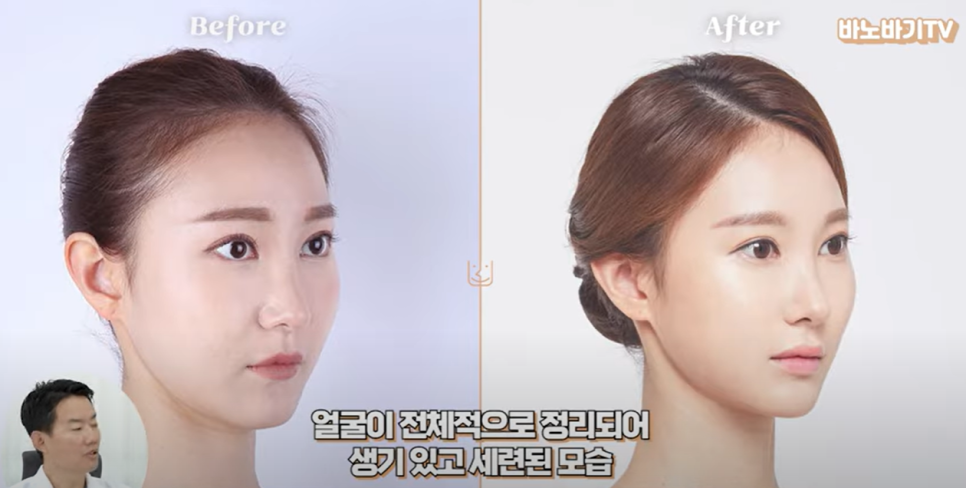 아테콜 필러의 장점과 아테콜 추천 부위는?! 관련 이미지 10