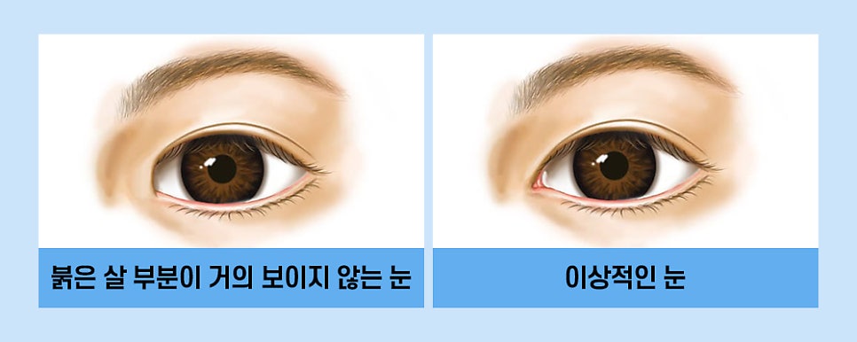 매력적인 눈매! 트임 성형만으로도 개선할 수 있습니다. 관련 이미지 2