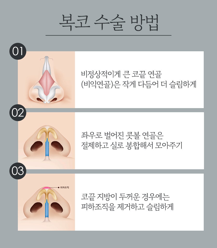 복코 성형, 뭉툭한 코를 세련되고 슬림한 코로 개선 관련 이미지 5