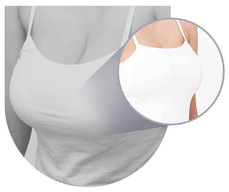 신체 균형을 위한 가슴 축소술! 관련 이미지 2