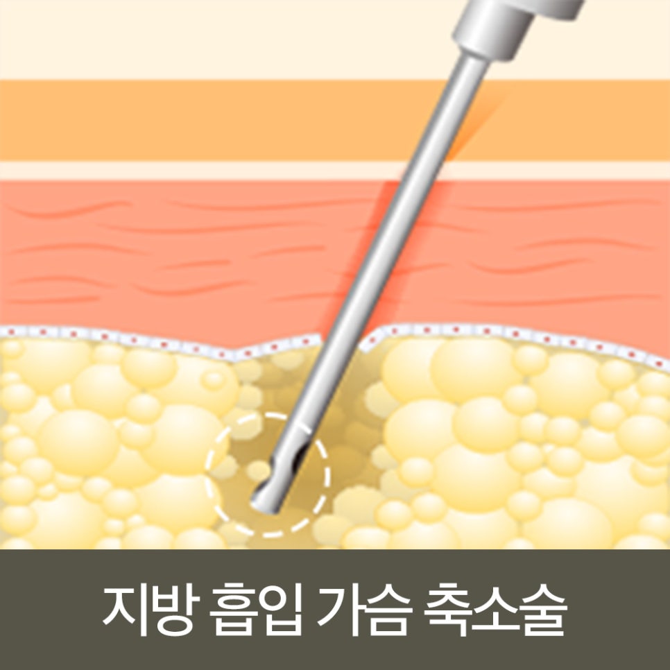 신체 균형까지 고려한 바노바기 가슴 축소 수술법 관련 이미지 3