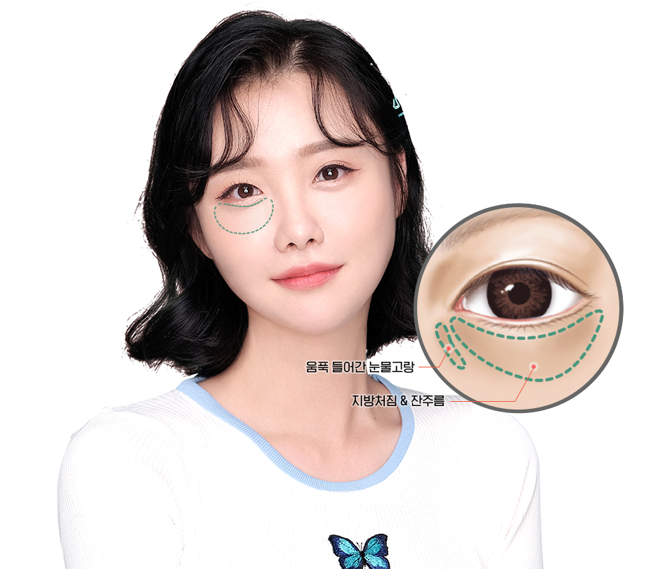 눈 밑 주름, 다크서클 눈 밑 지방재배치로 개선할 수 있습니다. 관련 이미지 2