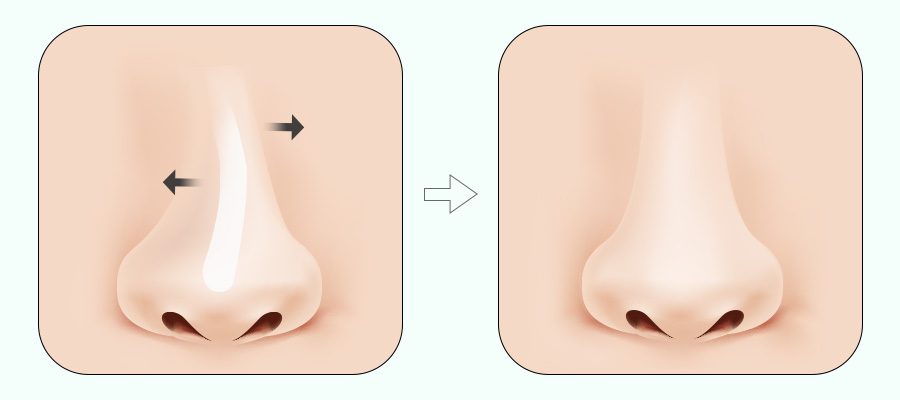코 재수술! 원인에 따라 달라지는 수술법 관련 이미지 9