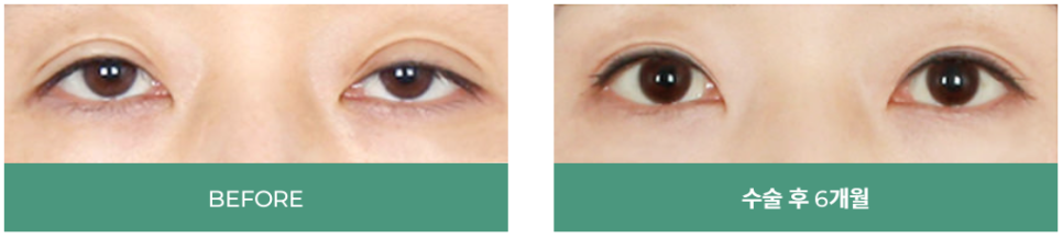 눈매교정잘하는병원 바노바기는 확실합니다. 관련 이미지 4