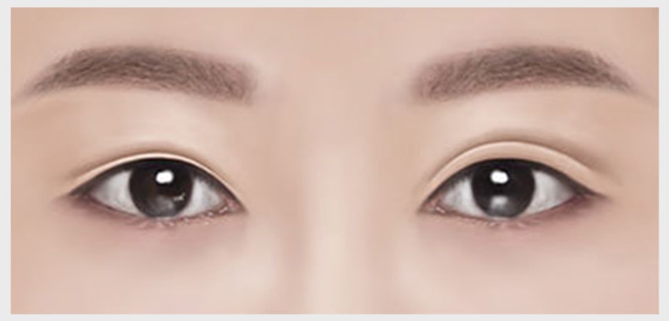 쌍꺼풀 재수술이 필요한 유형과 원인에 맞는 재수술 방법 관련 이미지 3