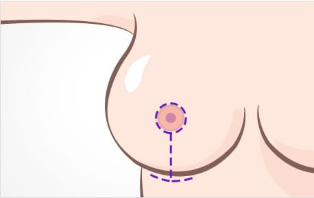 가슴처짐수술 회복과 흉터에 더욱 신경 써야 합니다. 관련 이미지 5