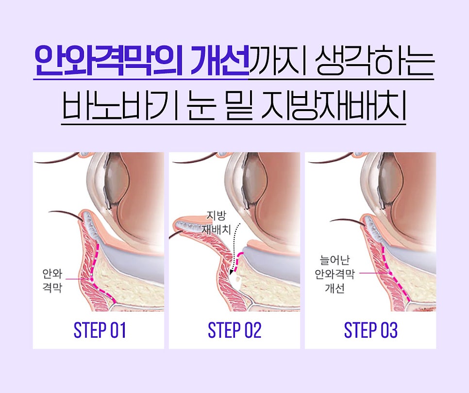 볼록한 눈 밑, 다크서클 한 번에 개선하는 눈밑지방재배치 관련 이미지 3