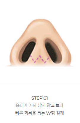 남자에게 맞는 코 성형과 개선 방법! 관련 이미지 6