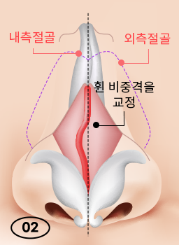 휘어진 콧대와 코 속을 한 번에 바로잡는 휜코 성형 관련 이미지 6