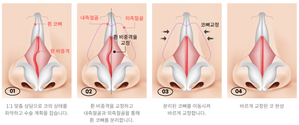 휜코, 바르고 곧은 코라인으로! 관련 이미지 5
