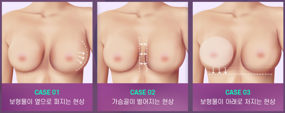 바노바기 프리미엄 보형물, 모티바 더 퍼플! 관련 이미지 2
